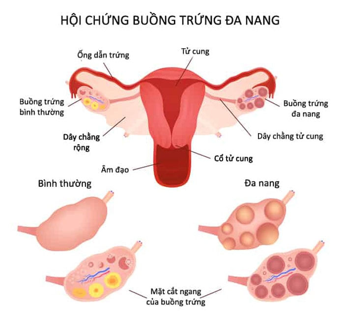buồng trứng đa nang