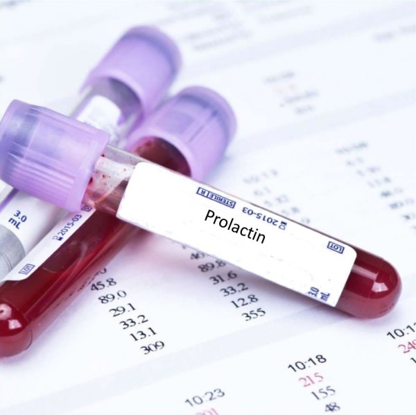 prolactin máu cao qua xét nghiệm