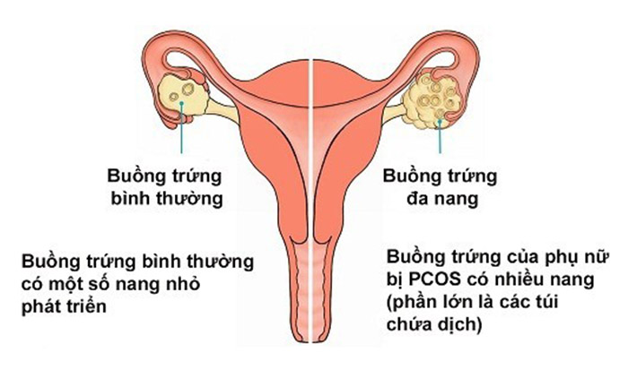 hội chứng buồng trứng đa nang PCOS